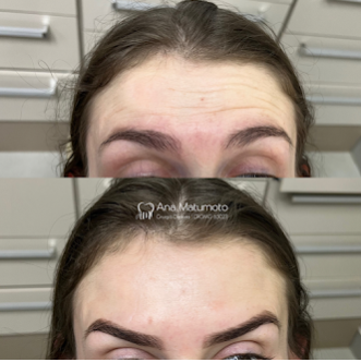 Antes e depois — toxina botulínica